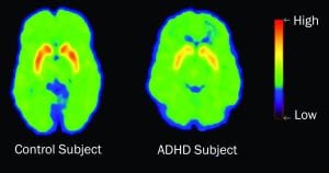 This PET scan shows that subjects suffering ADHD have lower levels of dopamine transporters in the nucleus accumbens than control subjects. This is a test result from a brain-imaging study conducted at the U.S. Department of Energy's Brookhaven National Laboratory in collaboration with Mount Sinai School of Medicine in New York.